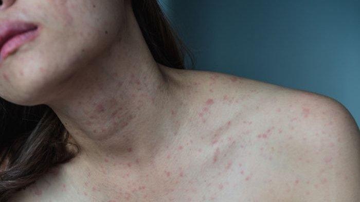 Penyakit Lupus