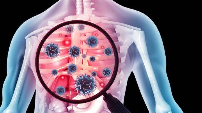 Penyakit Tuberculosis